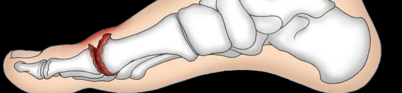 Hallux Rigidus